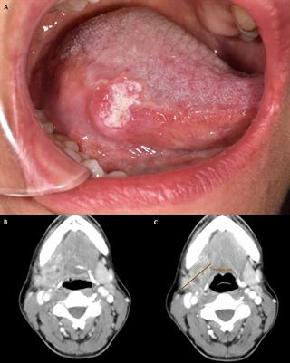 Neoadjuvant Immunotherapy of Oral Squamous Cell Carcinoma: Case Report and Assessment of Histological Response